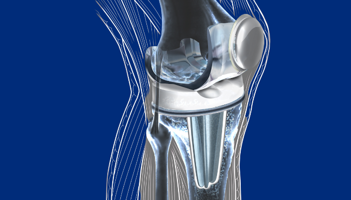 Knee Replacement Surgery in Dubai