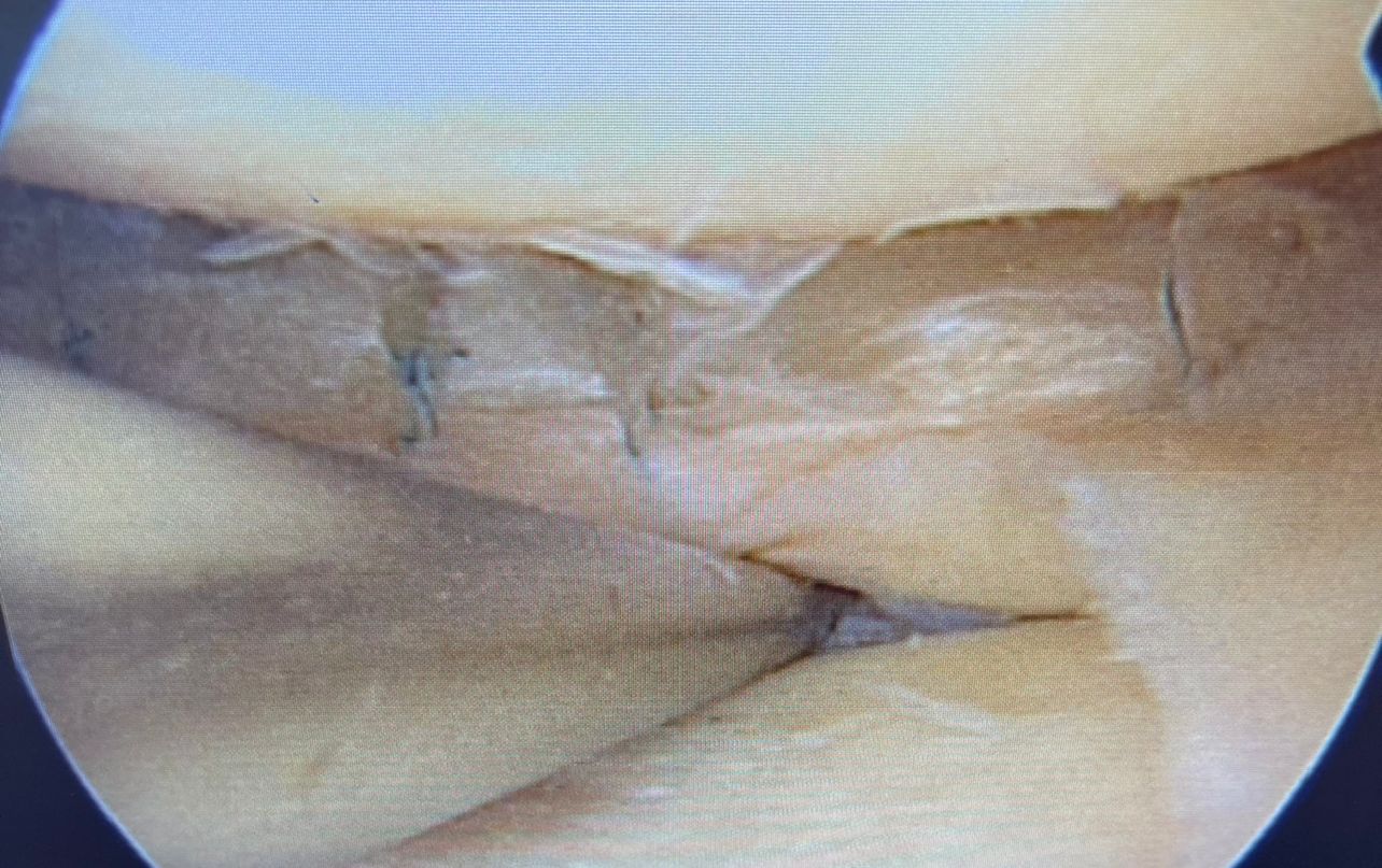 Meniscal surgery in dubai | Dr Rik Kundra (1)