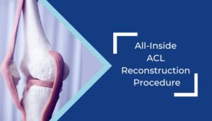 all inside ACL reconstruction
