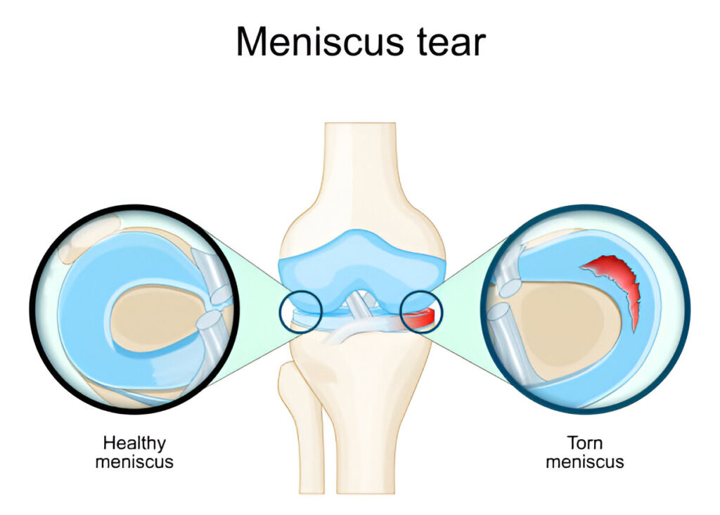 Does a torn meniscus need surgery