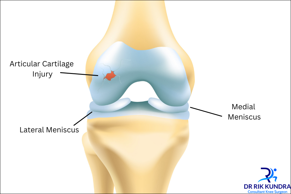 Articular Cartilage Surgery In Dubai - Dr Rik Kundra