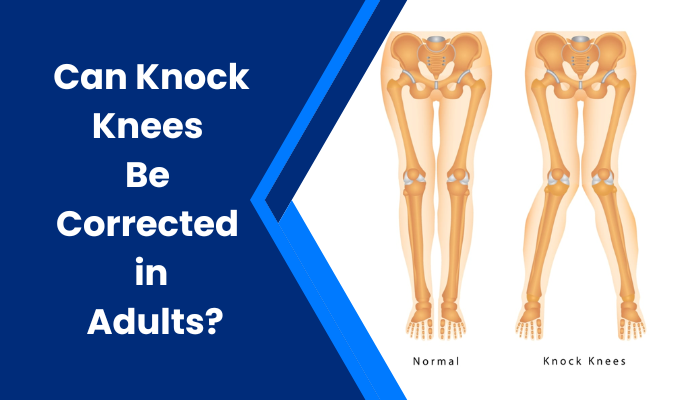 Can Knock Knees Be Corrected in Adults?